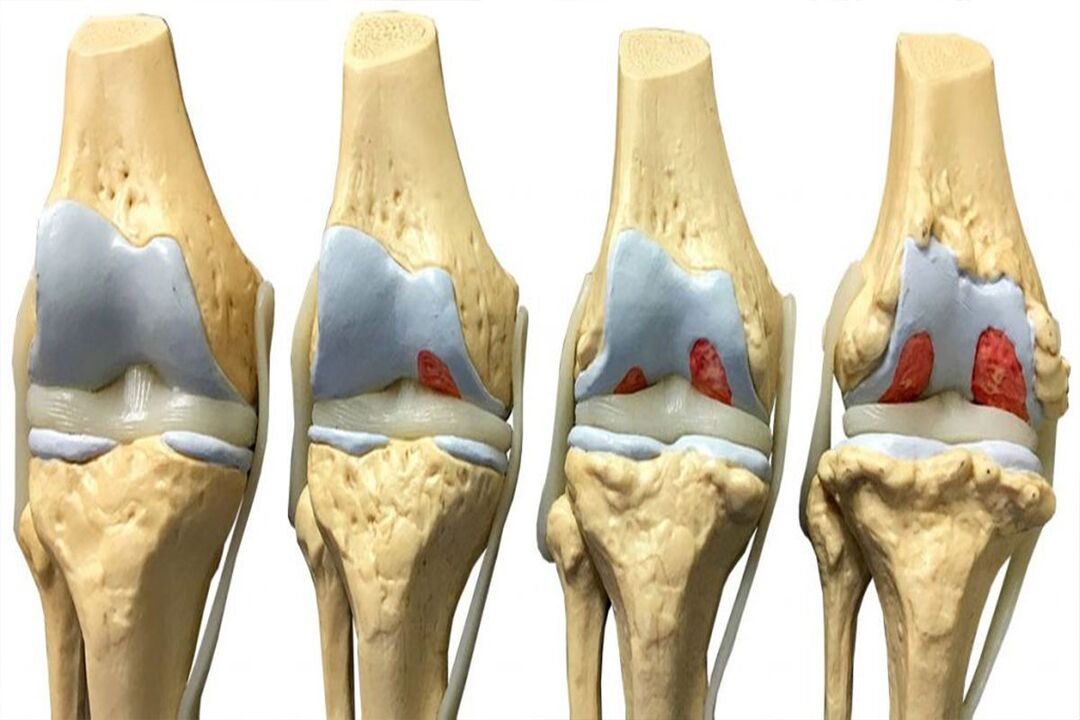 qonaxên pêşveçûna arthrosis