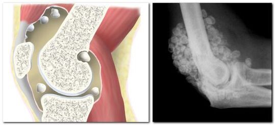 chondromatosis bi êşa di movika hip de